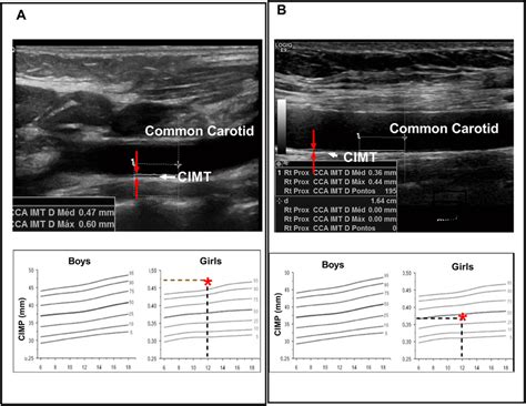 intima-media thickness measurement|what does cimt stand for.